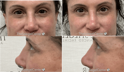 Non-Surgical Rhinoplasty / Nose Filler Before & After Gallery - Patient 707017 - Image 1