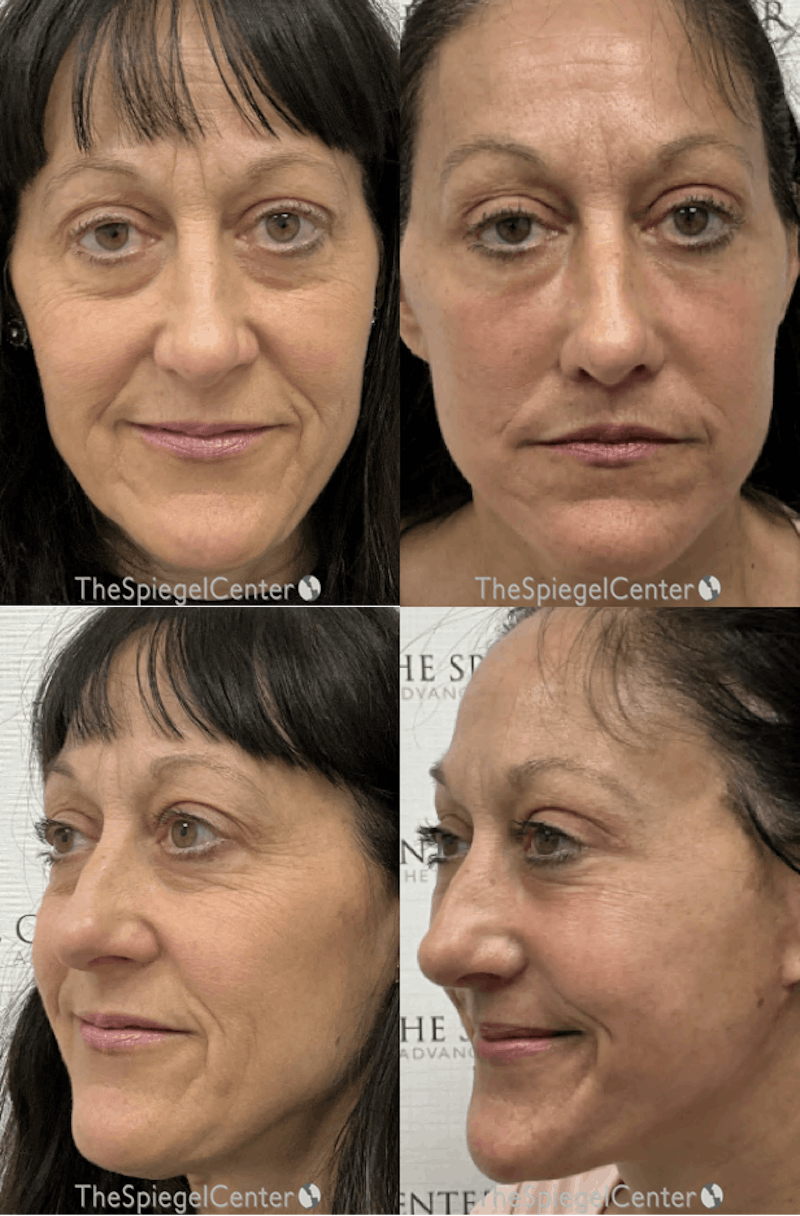 Facelift Before & After Gallery - Patient 318322 - Image 1