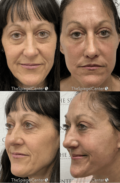 Facelift Before & After Gallery - Patient 318322 - Image 1