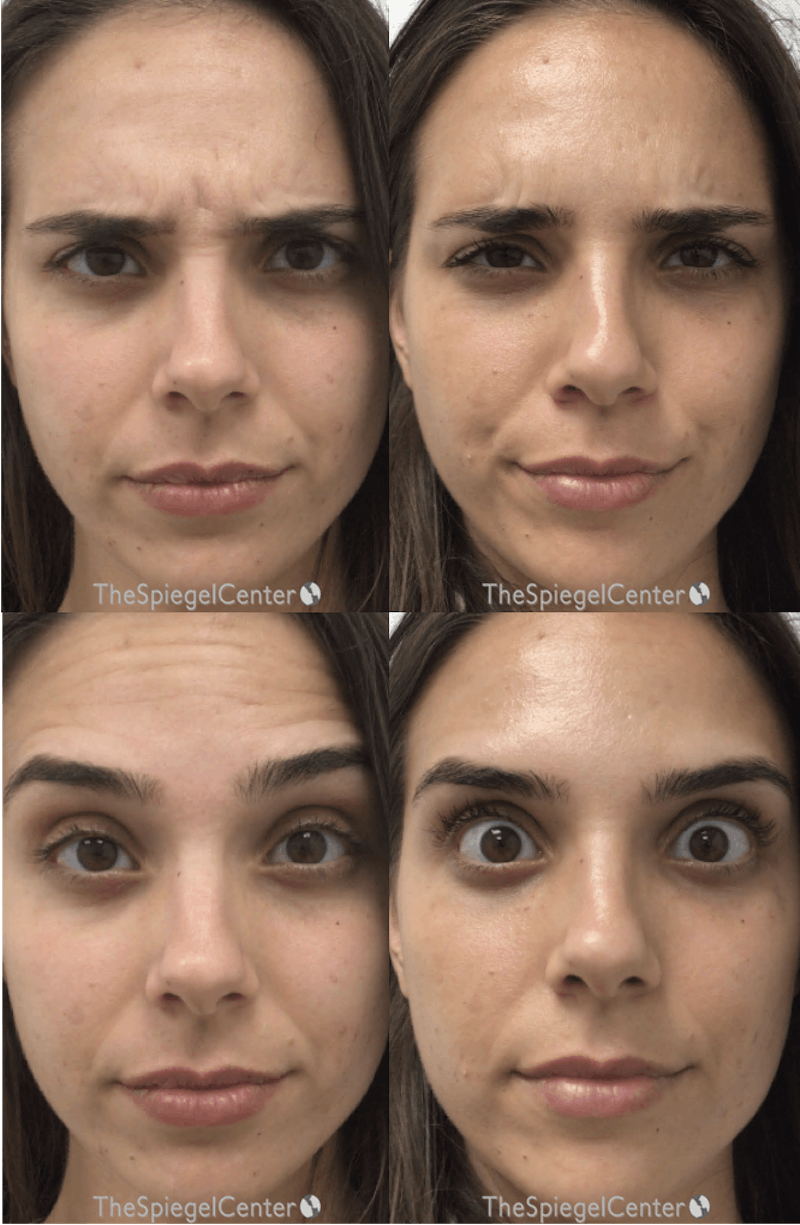 Botox / Dysport / Jeuveau / Xeomin Before & After Gallery - Patient 193912871 - Image 1