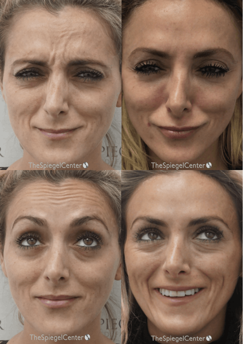 Botox / Dysport / Jeuveau / Xeomin Before & After Gallery - Patient 310059 - Image 1