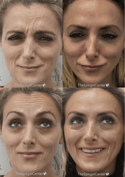 Botox / Dysport / Jeuveau / Xeomin Before & After Gallery - Patient 310059 - Image 1