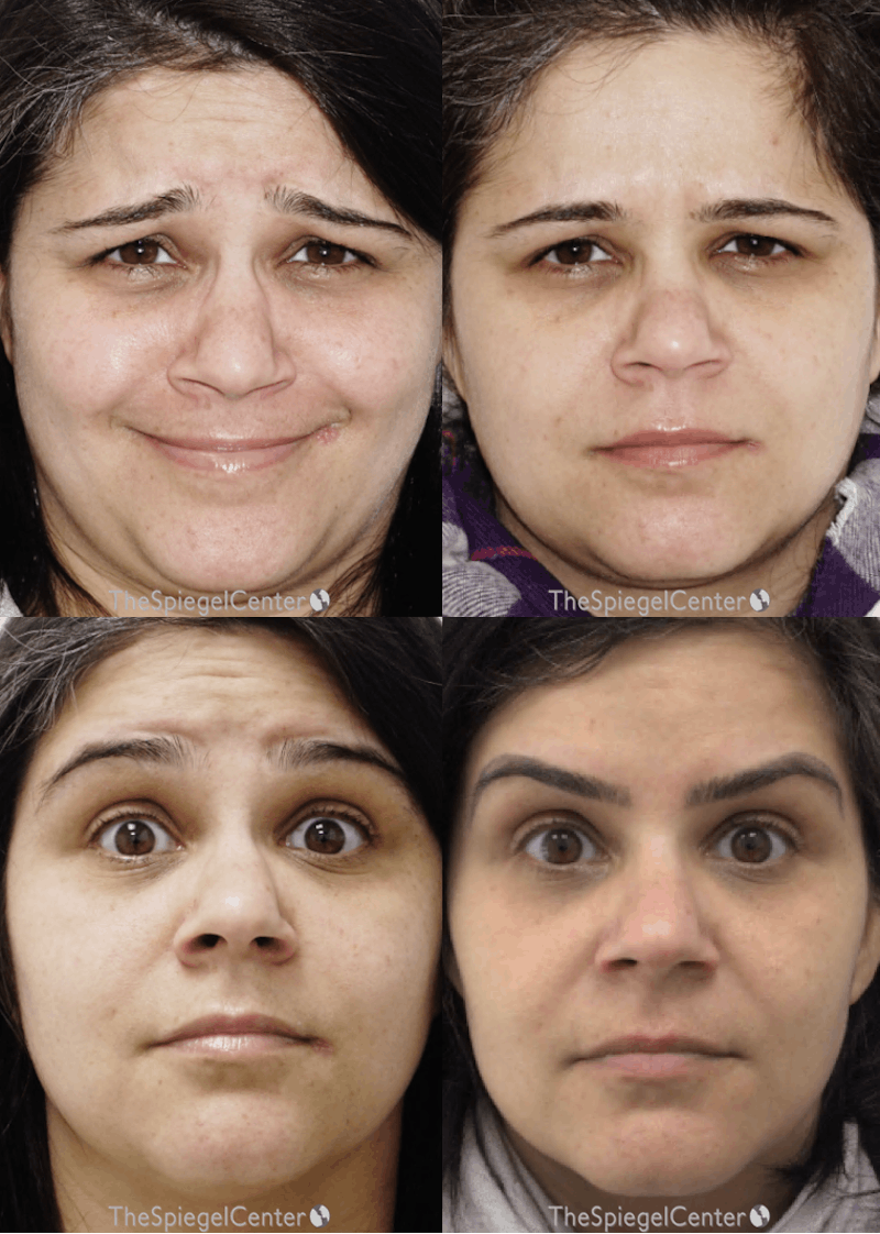 Botox / Dysport / Jeuveau / Xeomin Before & After Gallery - Patient 755649 - Image 1
