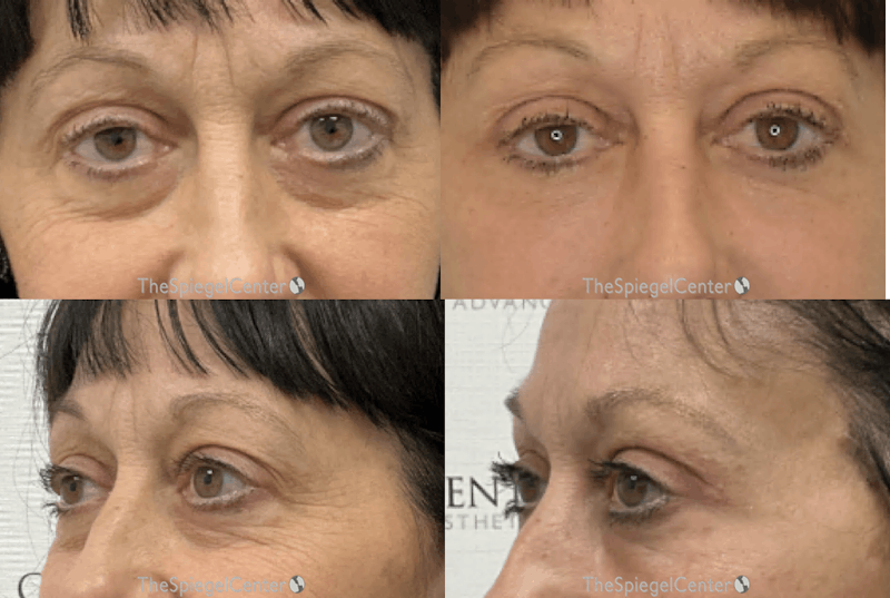 Blepharoplasty Before & After Gallery - Patient 282696 - Image 1