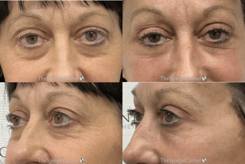 Facial Fat Grafting Before & After Gallery - Patient 786573 - Image 1