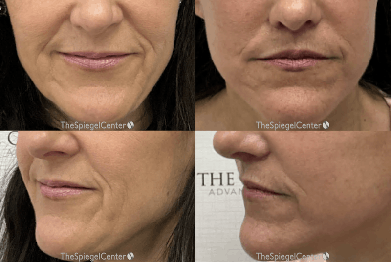 Facial Fat Grafting Before & After Gallery - Patient 314785 - Image 1