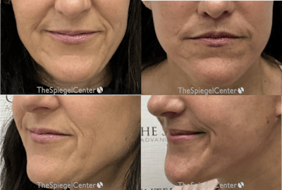Lip Lift Before & After Gallery - Patient 360579 - Image 1