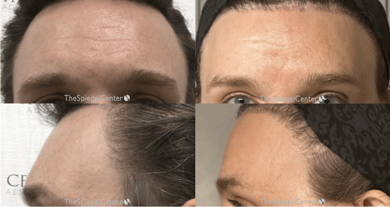 Forehead Contouring Before & After Gallery - Patient 244536 - Image 1