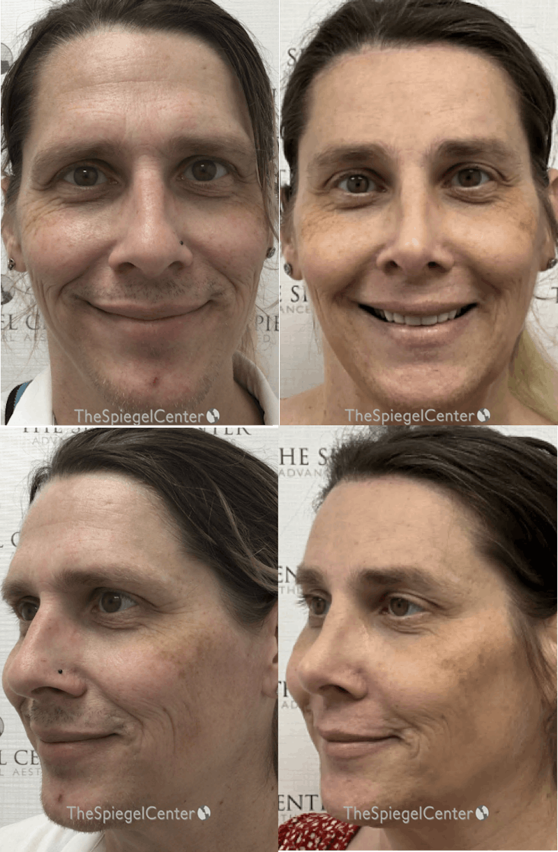 FFS Before & After Gallery - Patient 735014 - Image 1