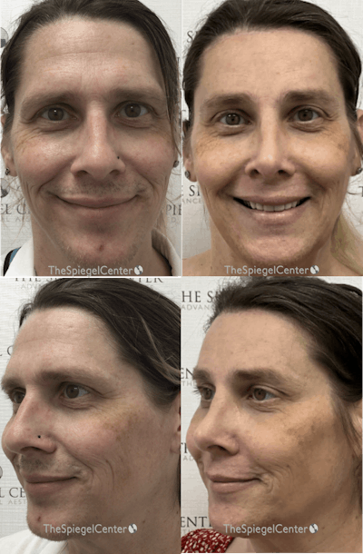 FFS Before & After Gallery - Patient 735014 - Image 1