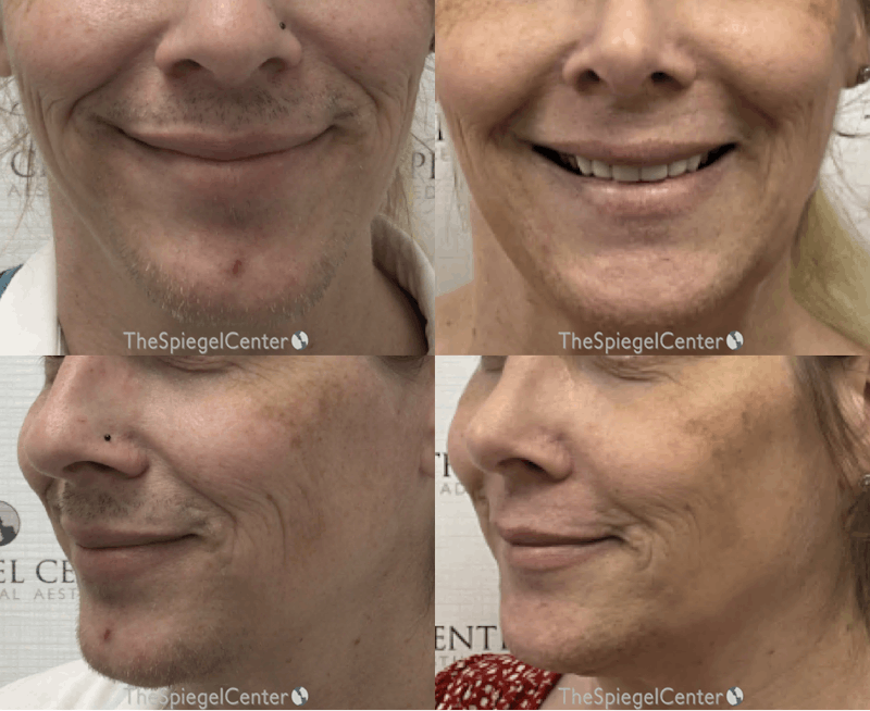 Mandible Contouring Before & After Gallery - Patient 129568 - Image 1