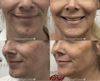 Mandible Contouring Before & After Gallery - Patient 129568 - Image 1