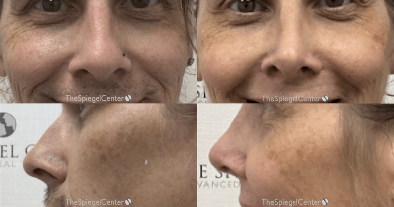 Cheek Implants Before & After Gallery - Patient 114081 - Image 1