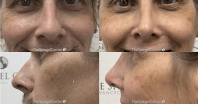 Cheek Implants Before & After Gallery - Patient 114081 - Image 1
