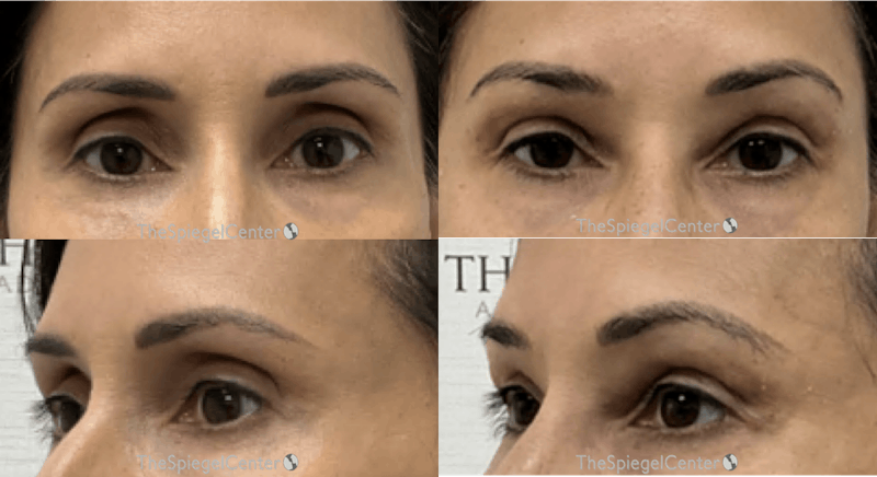 Upper Eyelid Filler Before & After Gallery - Patient 863503 - Image 1