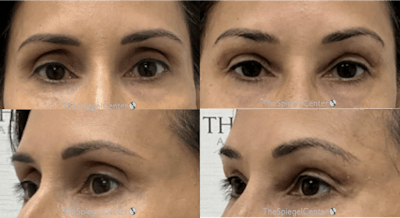 Upper Eyelid Filler Before & After Gallery - Patient 863503 - Image 1