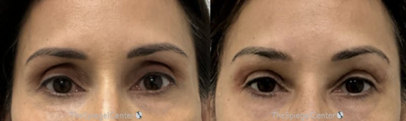 Temple Filler Before & After Gallery - Patient 363755 - Image 1