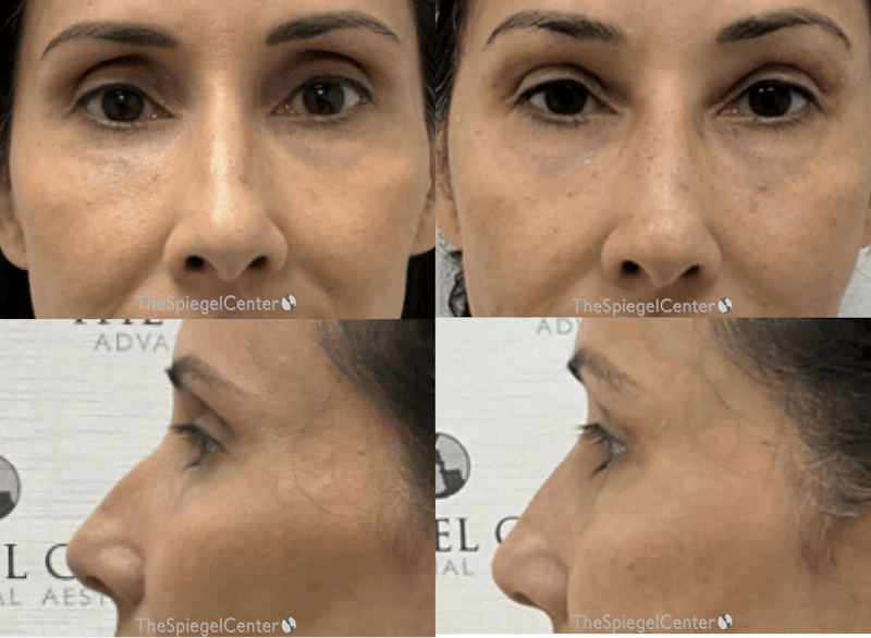 Non-Surgical Rhinoplasty / Nose Filler Before & After Gallery - Patient 108127 - Image 1
