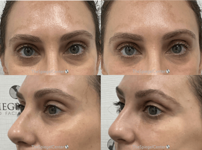 Tear Trough / Under Eye Fillers Before & After Gallery - Patient 279078 - Image 1
