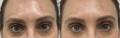 Temple Filler Before & After Gallery - Patient 793068 - Image 1