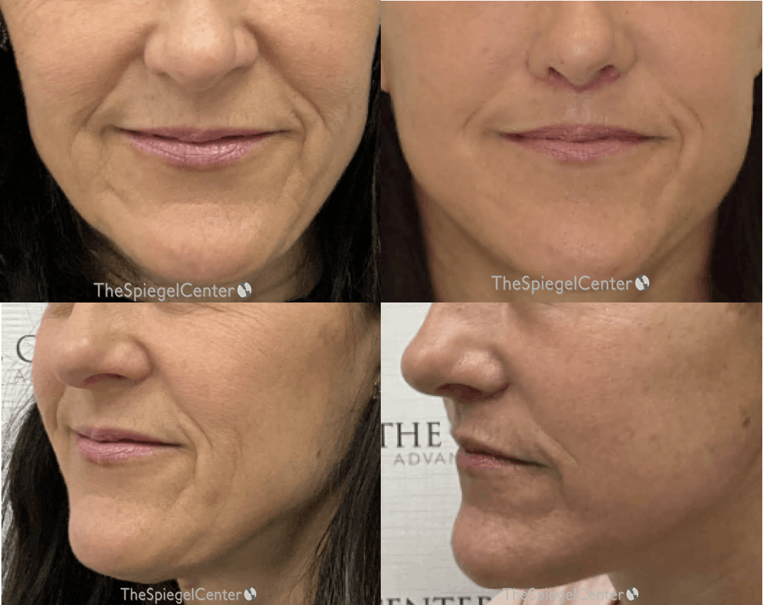 Ellacor Before & After Gallery - Patient 292708 - Image 1