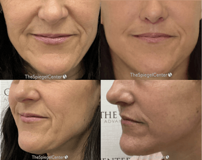 Ellacor Before & After Gallery - Patient 292708 - Image 1