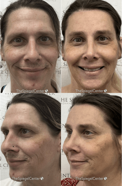 Facial Fat Grafting Before & After Gallery - Patient 280427 - Image 1