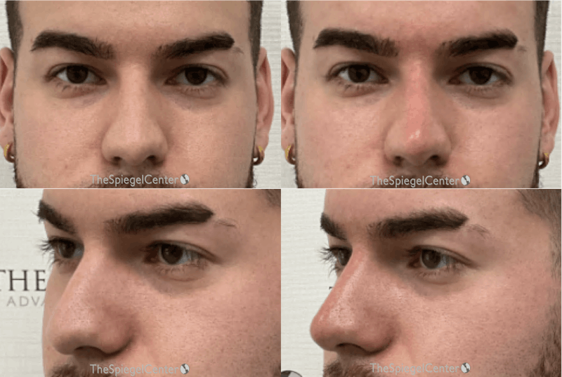 Non-Surgical Rhinoplasty / Nose Filler Before & After Gallery - Patient 100541 - Image 1