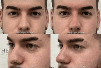 Non-Surgical Rhinoplasty / Nose Filler Before & After Gallery - Patient 100541 - Image 1