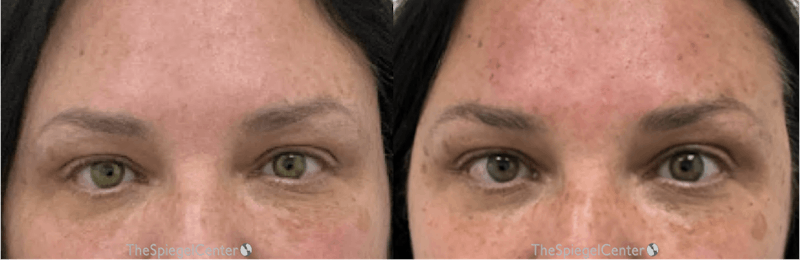 Temple Filler Before & After Gallery - Patient 228938 - Image 1