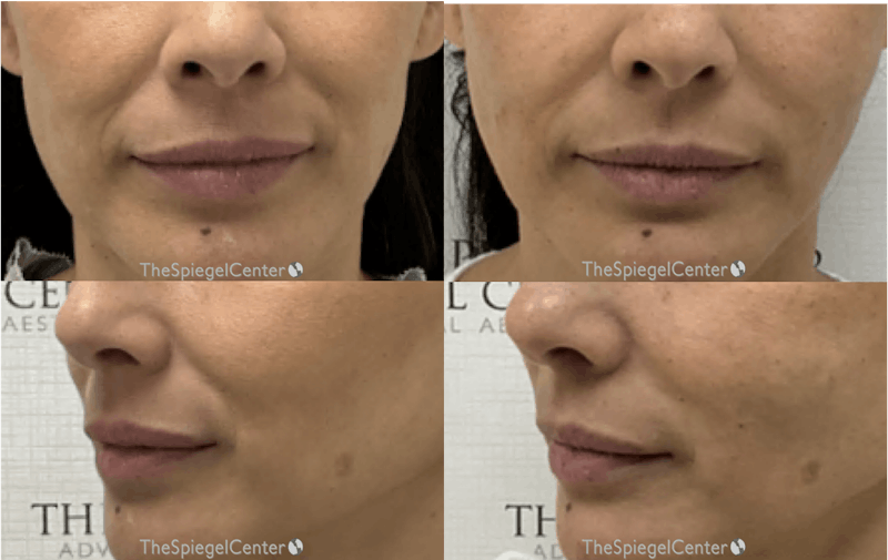 Nasolabial Fold Filler Before & After Gallery - Patient 262171 - Image 1