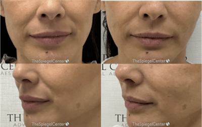 Nasolabial Fold Filler Before & After Gallery - Patient 262171 - Image 1