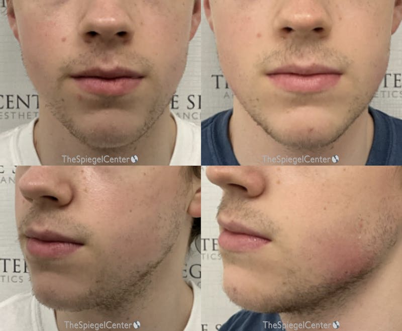 Chin Filler Before & After Gallery - Patient 373106 - Image 1