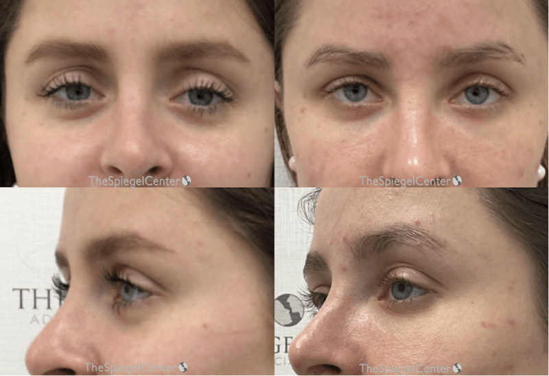 Upper Eyelid Filler Before & After Gallery - Patient 417237 - Image 1