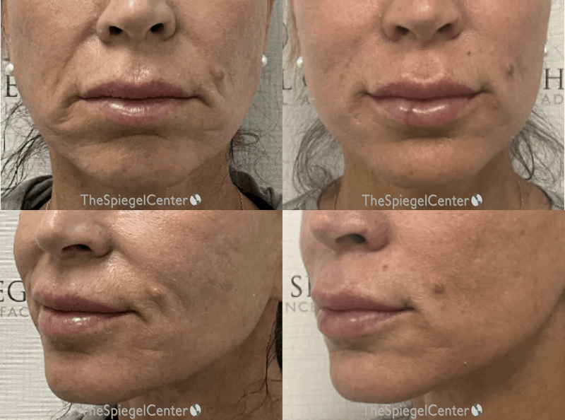 Nasolabial Fold Filler Before & After Gallery - Patient 155901 - Image 1