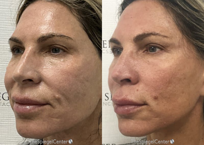 IPL / Intense Pulse Light Before & After Gallery - Patient 333591 - Image 1