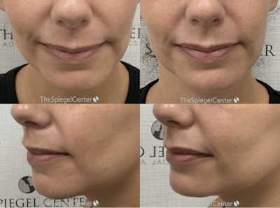 Chin Filler Before & After Gallery - Patient 372788 - Image 1