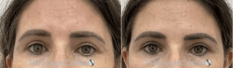 Temple Filler Before & After Gallery - Patient 408228 - Image 1