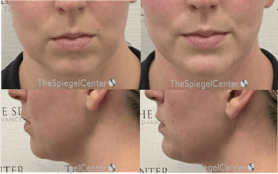 Chin Filler Before & After Gallery - Patient 326674 - Image 1