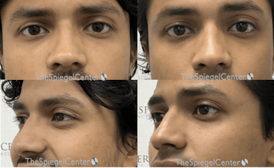 Revision Rhinoplasty Before & After Gallery - Patient 263738 - Image 1