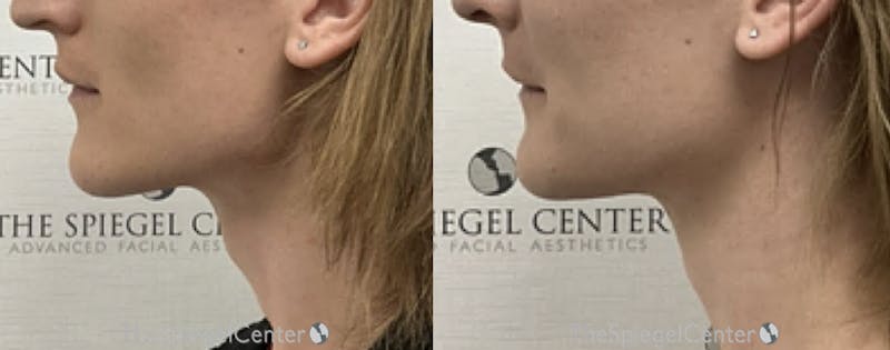 Trachea Shave Before & After Gallery - Patient 262412 - Image 1