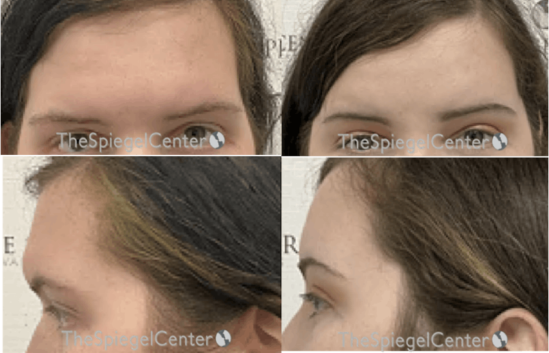 Forehead Contouring Before & After Gallery - Patient 298235 - Image 1
