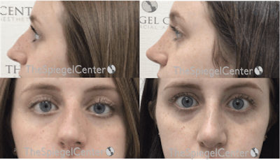 Rhinoplasty Before & After Gallery - Patient 163060 - Image 1