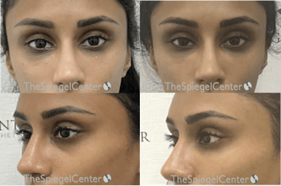 Tear Trough / Under Eye Fillers Before & After Gallery - Patient 166360 - Image 1