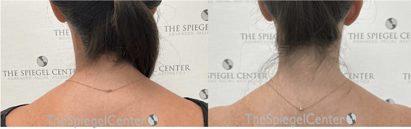 Trapezius Botox (TrapTox) Before & After Gallery - Patient 411509 - Image 1