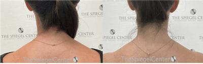 Trapezius Botox (TrapTox) Before & After Gallery - Patient 411509 - Image 1