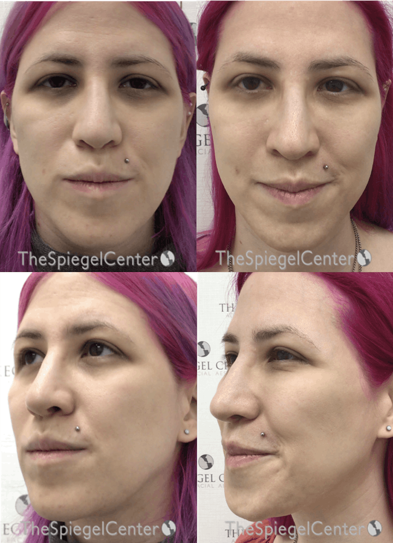 Masseter Botox Before & After Gallery - Patient 450788 - Image 1