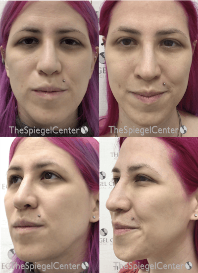 Masseter Botox Before & After Gallery - Patient 450788 - Image 1