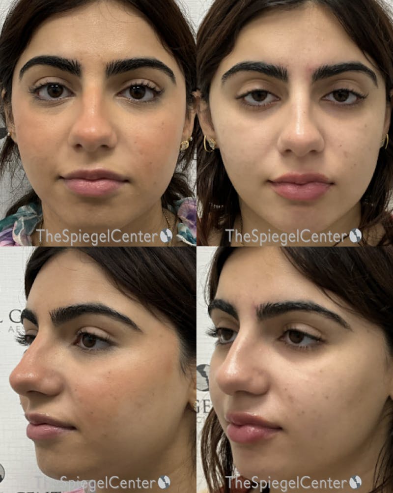 Masseter Botox Before & After Gallery - Patient 298778 - Image 1