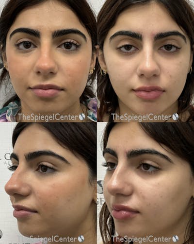 Masseter Botox Before & After Gallery - Patient 298778 - Image 1